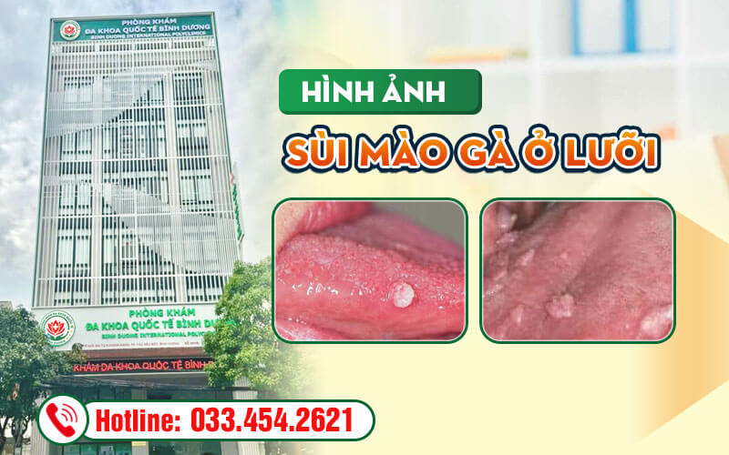 Hình ảnh sùi mào gà ở lưỡi