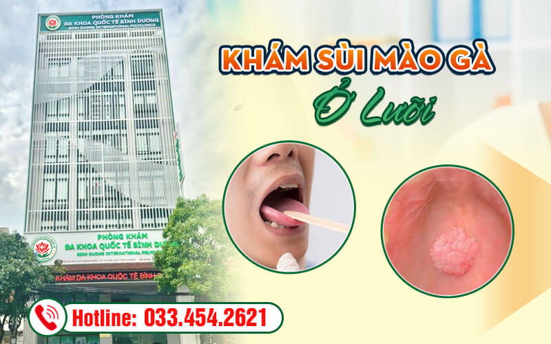 Khám sùi mào gà ở lưỡi sớm để có cách điều trị hiệu quả