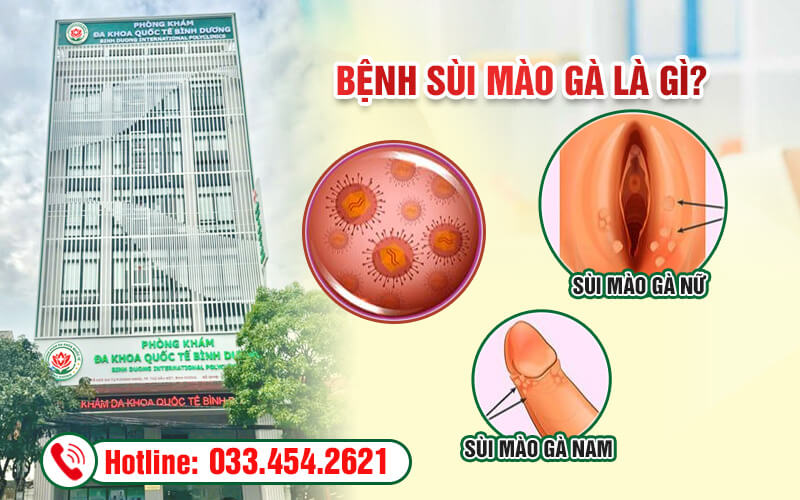 Bệnh sùi mào gà là gì?