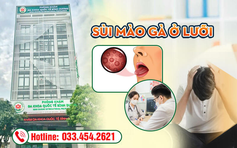 Sùi mào gà ở lưỡi gây cảm giác khó chịu cho người bệnh