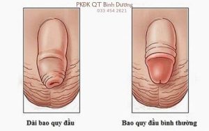 Nhận diện dấu hiệu bệnh dài bao quy đầu