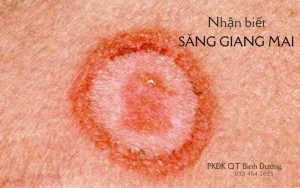 Nhận biết sự xuất hiện của săng giang mai