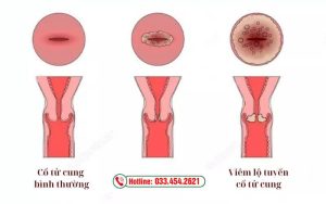 Tìm hiểu chung bệnh viêm lộ tuyến cổ tử cung