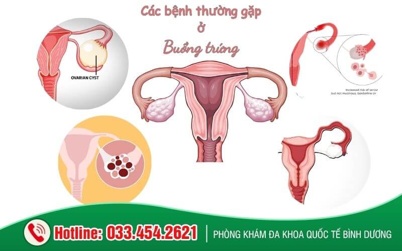 Những bệnh thường gặp ở buồng trứng
