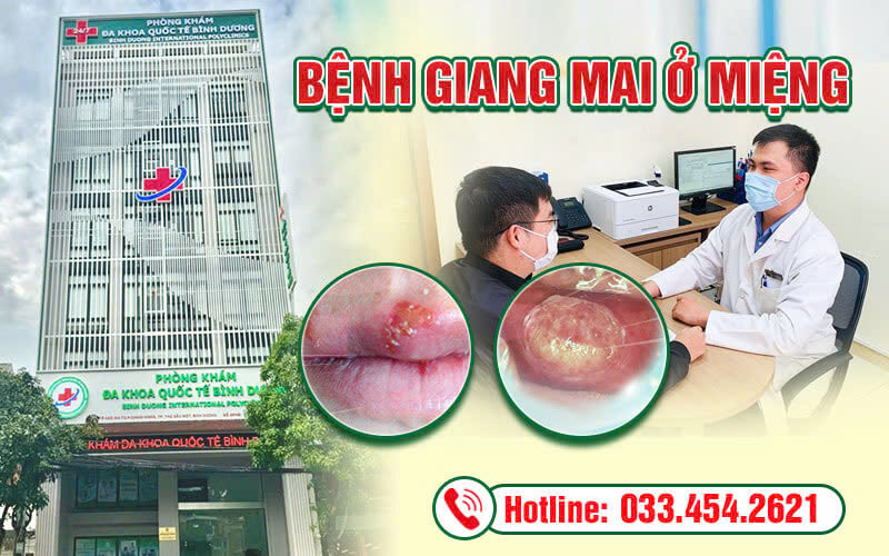 Tổng quan bệnh giang mai ở miệng