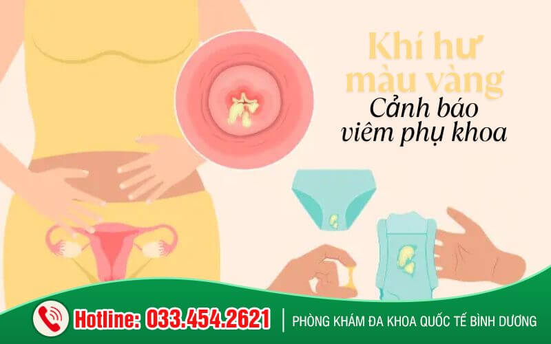 Ra khí hư màu vàng cũng là dấu hiệu cảnh báo viêm phụ khoa
