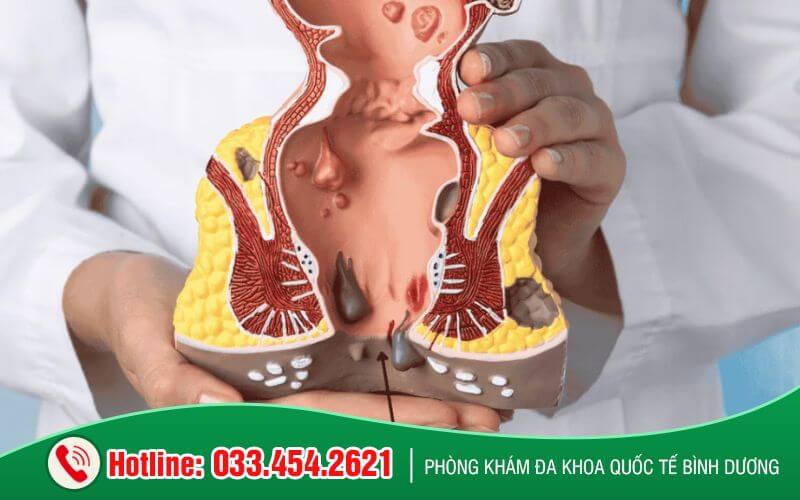 Tổng quan nứt kẽ hậu môn