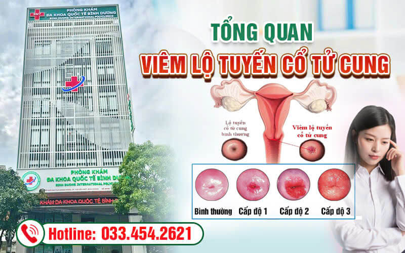 Tổng quan bệnh lý viêm lộ tuyến cổ tử cung