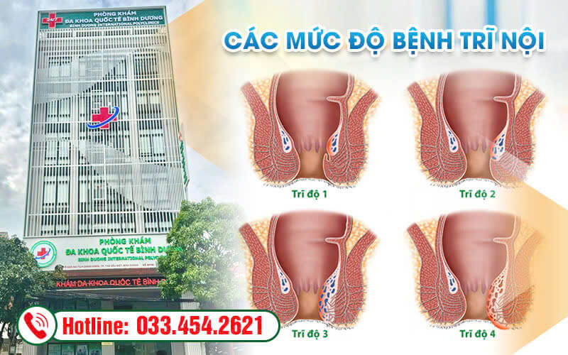 Hình ảnh các cấp độ bệnh trĩ nội